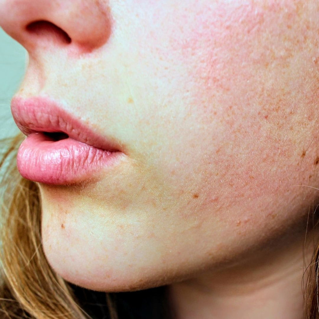 Natural Remedies for Sensitive Skin